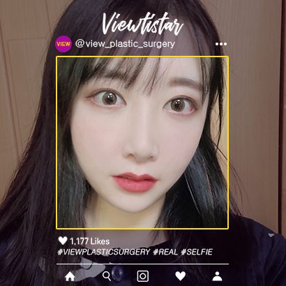 [3 Types Face Countouring+Rhinoplasty+Double Eyelid Revisional Surgery+Pyriform Augmentation+Fat Graft] An Bogyeong