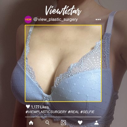 [Breast Augmentation (Motiva)] Sia