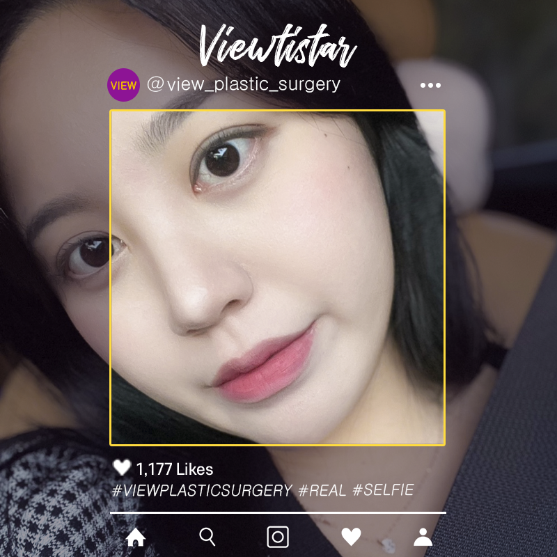 [Double Eyelid Revisional Surgery] Jo Heejoo