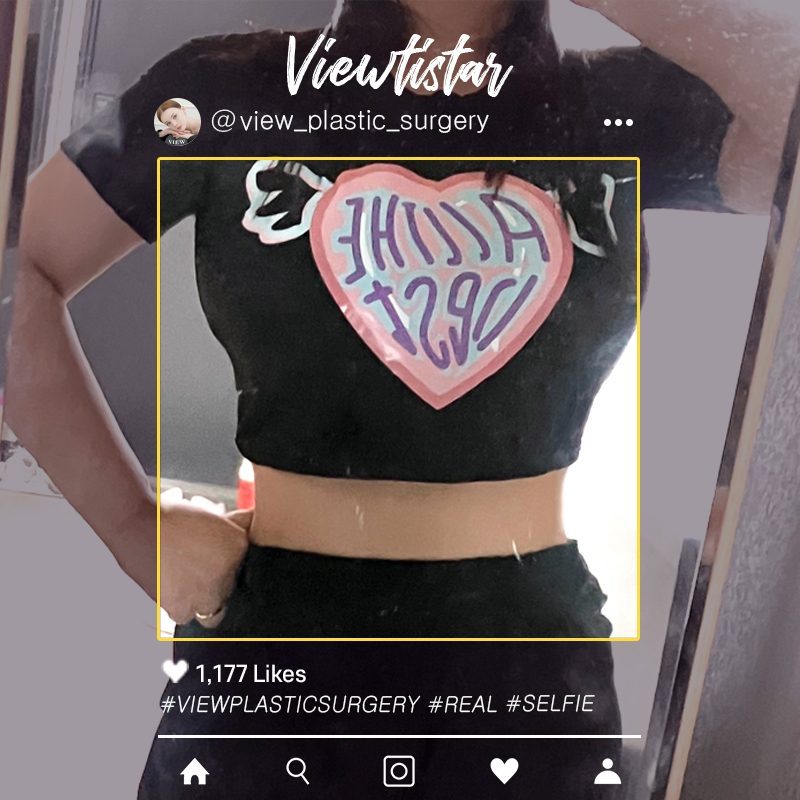 [Liposuction (Abdomen, Back)] Lee Heejin | Plastic Surgery Korea