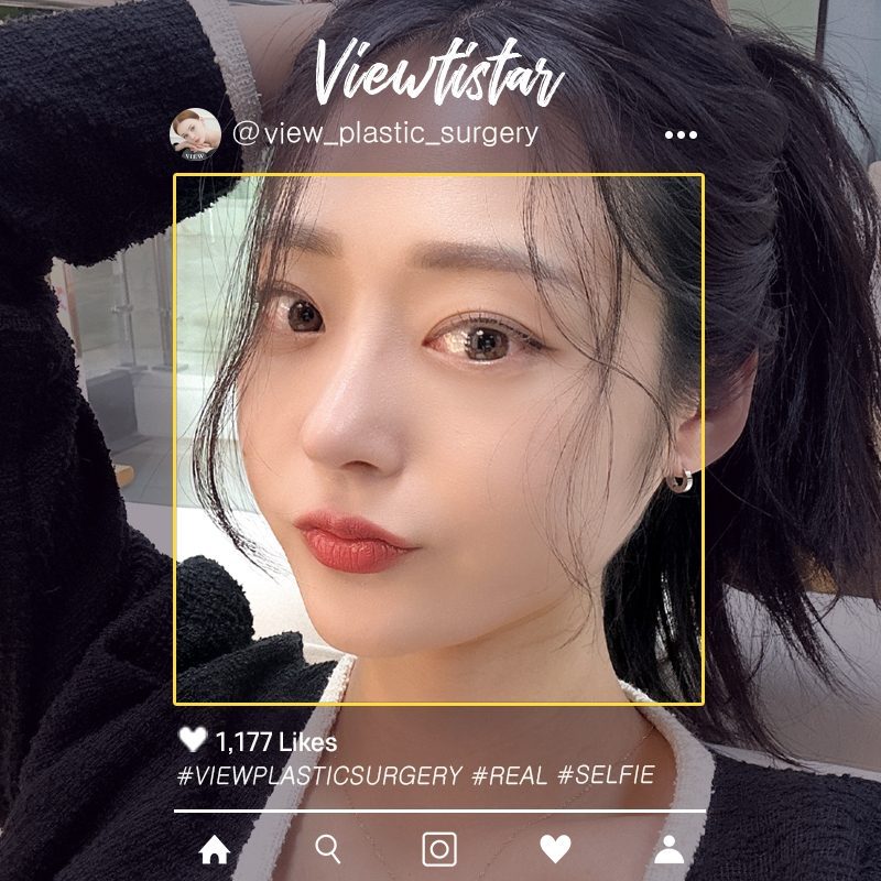 [Rhinoplasty + Under Eye Fat Reposition] Lee hyeri | Plastic Surgery Korea