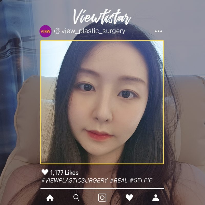 [Facial Contouring+Rhinoplasty+Double Eyelid Surgery] Lee Yujin | Plastic Surgery Korea