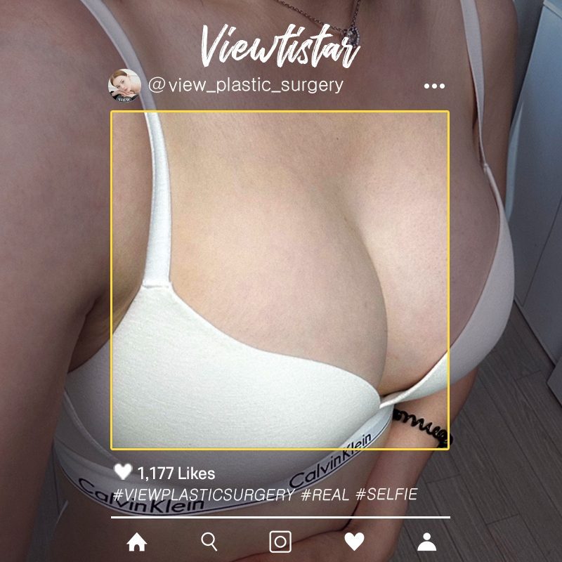 [Breast Augmentation (Sebbin)] Kang Doori | Plastic Surgery Korea