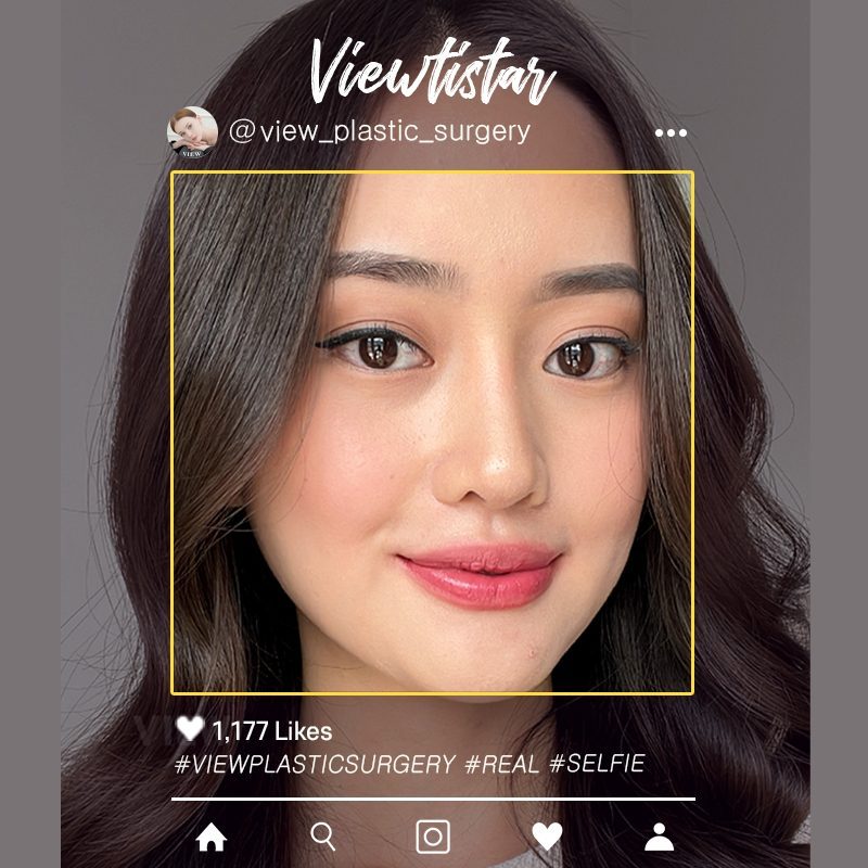 [3 Types Facial Contouring, Double Eyelid Surgery, Rhinoplasty] Priscilla setio | Plastic Surgery Korea