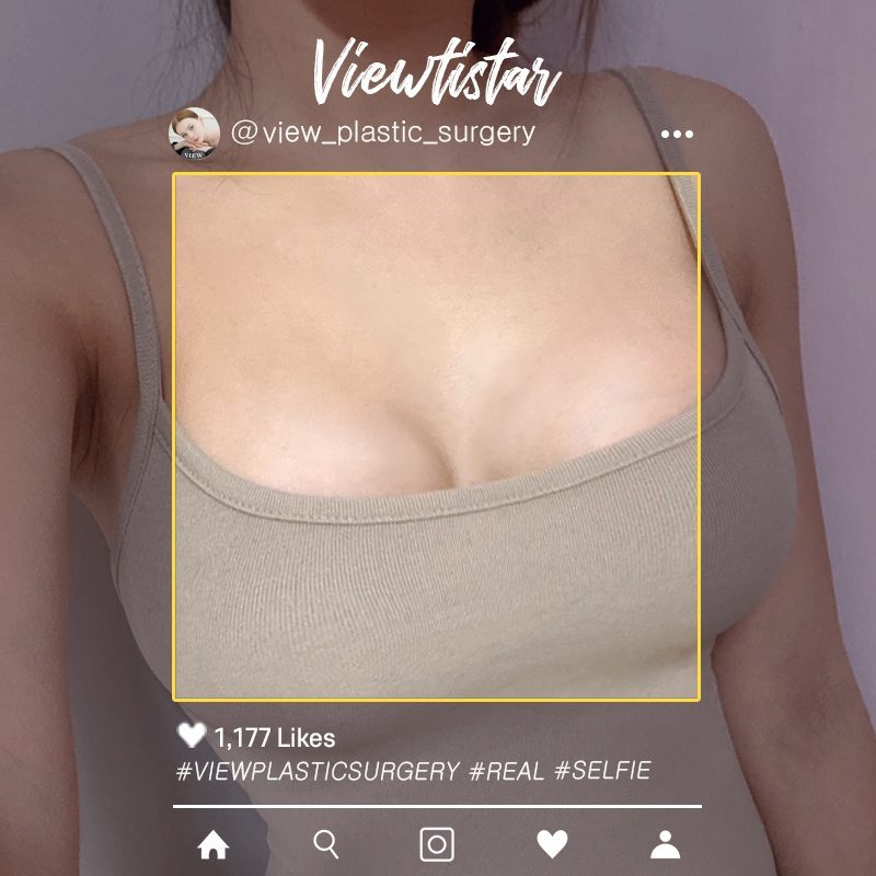[Breast Augmentation (Sebbin)] Han Yeounsil | Plastic Surgery Korea