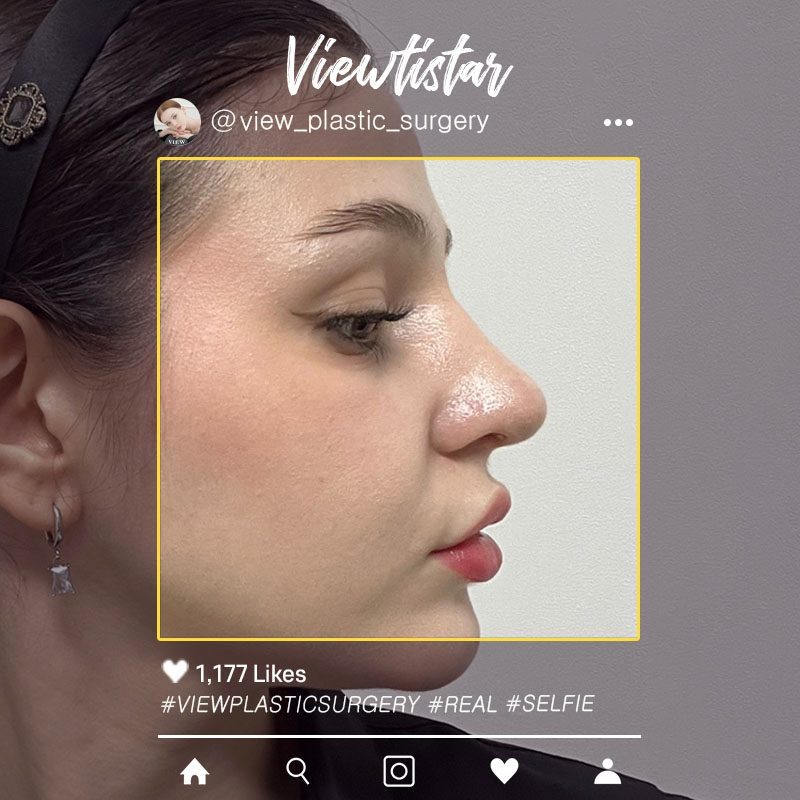 [Rhinoplasty] Maria | Plastic Surgery in Korea