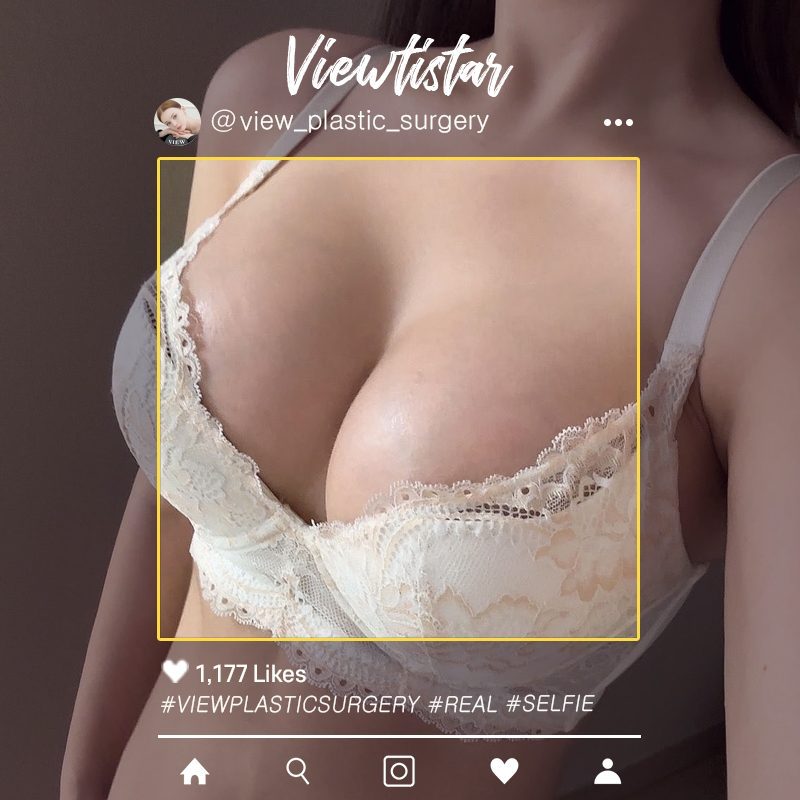 [Breast Augmentation (Motiva)] Lee Yumi | Plastic Surgery Korea