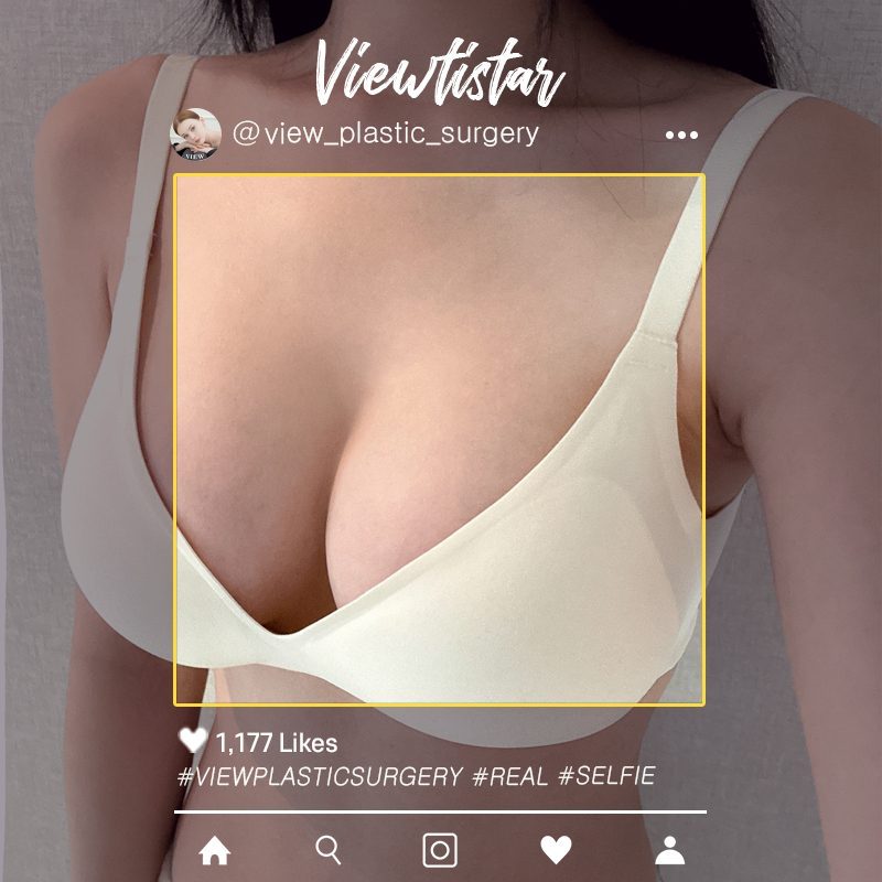 [Breast Augmentation (Mentor Boost)] Gu Dohee | Plastic Surgery Korea
